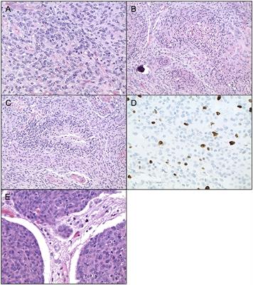 Review of Atypical and Anaplastic Meningiomas: Classification, Molecular Biology, and Management